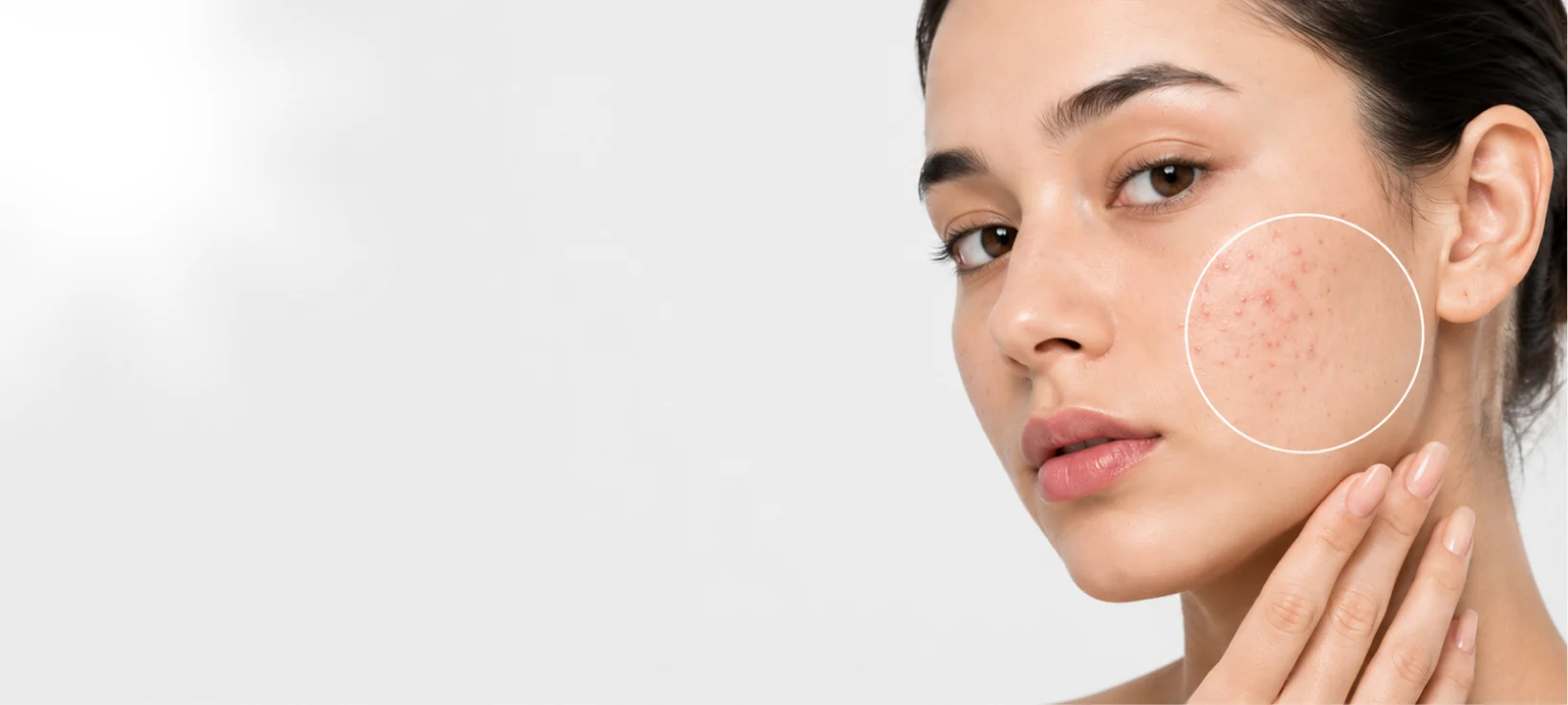 Woman touching her cheek with acne highlighted